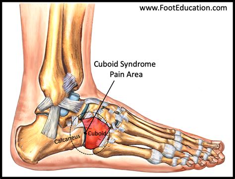 Cuboid Bone Pain