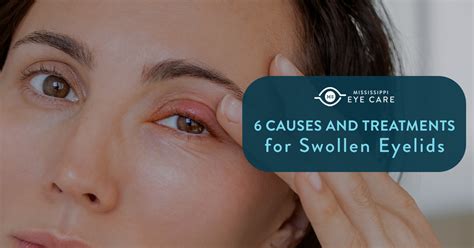 Cure Swollen Eyelids