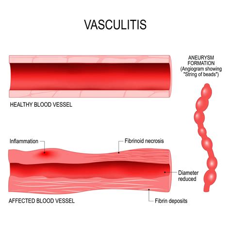 Cures For Vasculitis