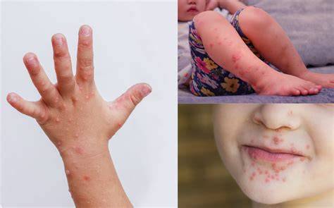 Cycle Of Hand Foot And Mouth