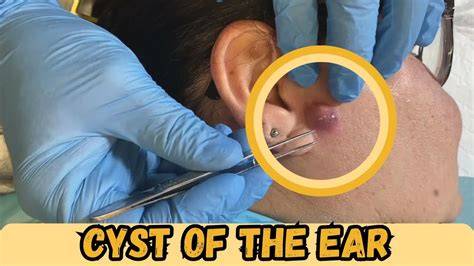 Cyst By The Ear