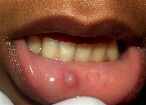 Cyst In Mouth