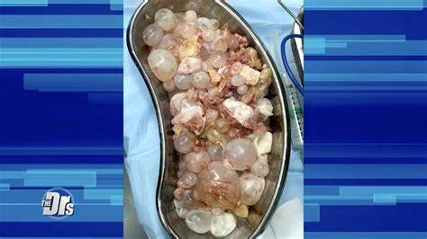 Cyst Inside The Stomach