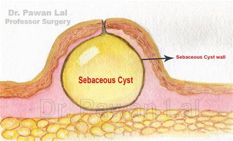 Cyst On Scrotum