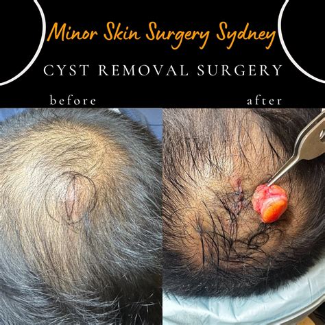 Cyst Removal Surgery Cost
