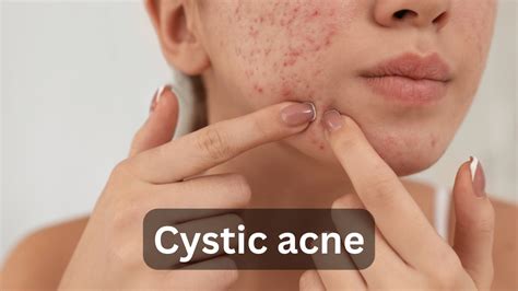 Cystic Acne Dermatology