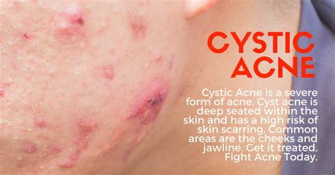 Cystic Breakout On Chin