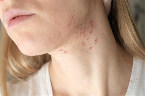 Cystic Zits On Neck