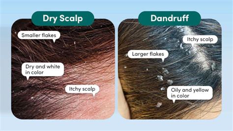Dandruff Or Dry Scalp