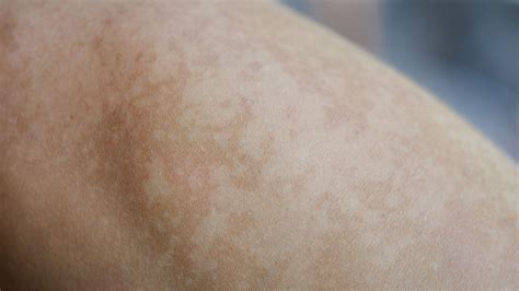 Dark Patches On Legs