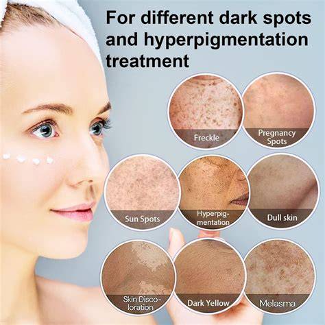 Dark Spots On Face