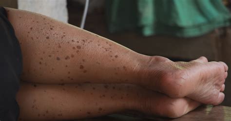 Dark Spots On Legs