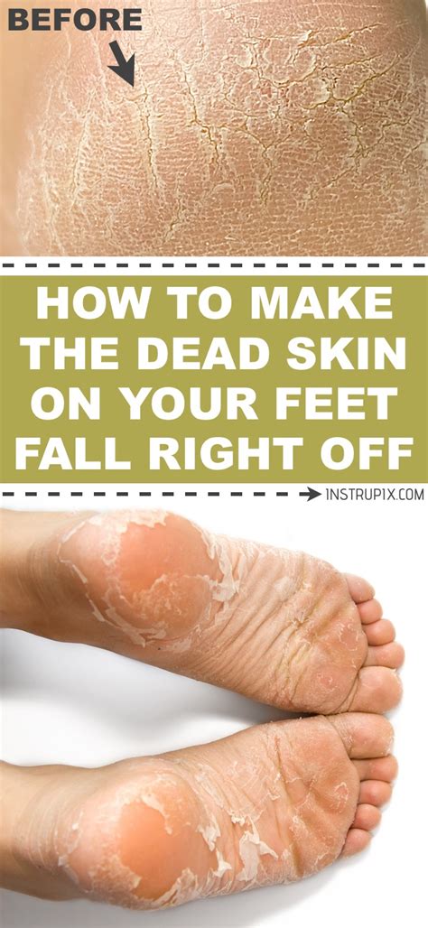 Dead Skin On Feet