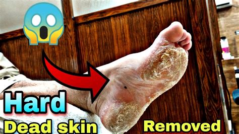 Dead Skin On Foot