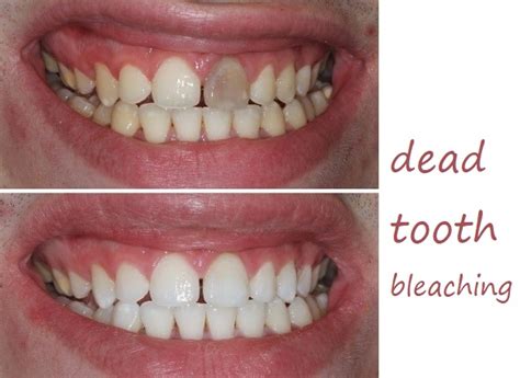 Dead Tooth Filling