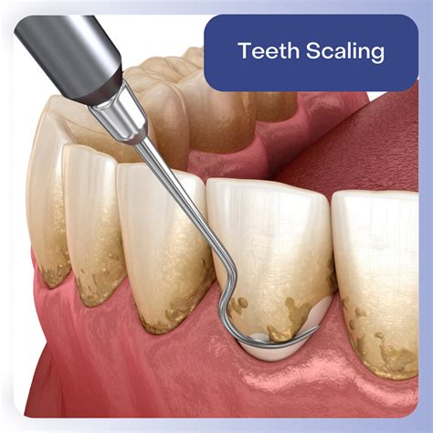 Deep Cleaning Dental