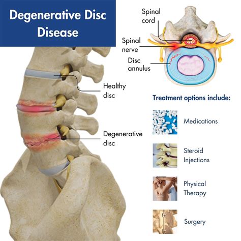 Degenerative In The Spine