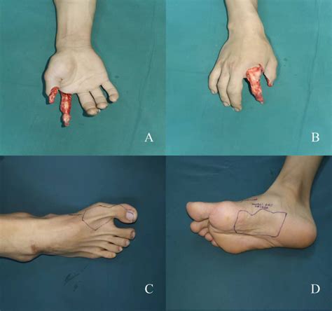 Degloving Injury Ring