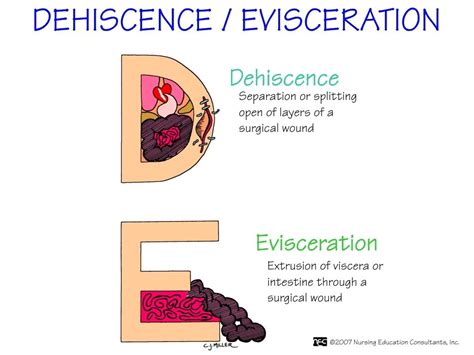 Dehiscence Vs Evisceration
