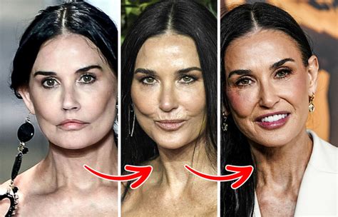 Demi Moore Face Surgeries
