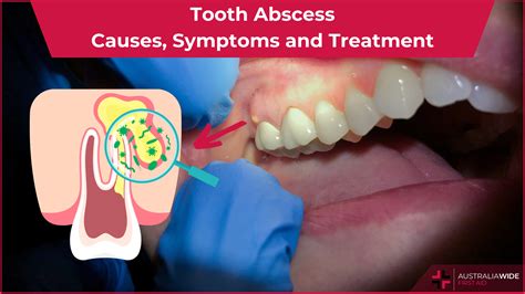 Dental Abscess Selfcare