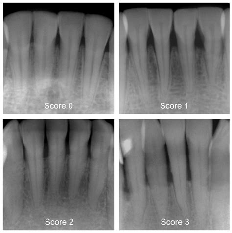 Dental Bone Loss
