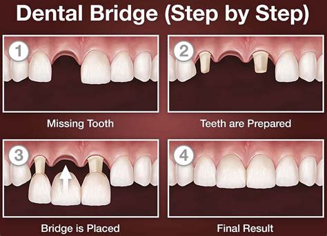 Dental Bridge Procedure