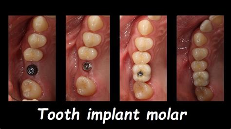Dental Implant Molar Tooth