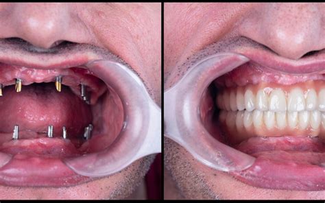 Dental Implants Full Mouth