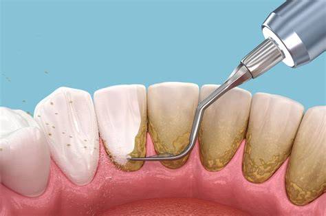 Dentist Deep Cleaning
