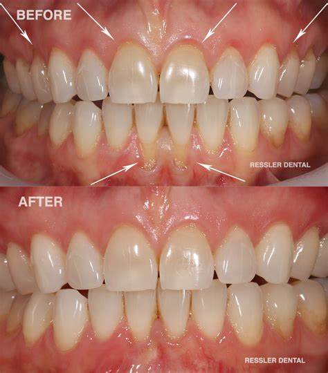 Dentist For Receding Gums