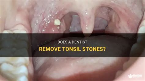 Dentist For Tonsil Stones