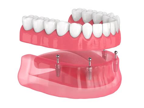 Denture Dental Implants