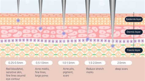 Depth Of Qure Microneedling
