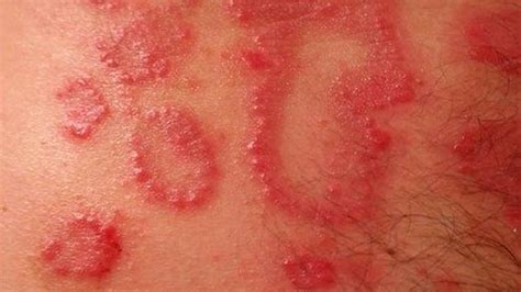 Dermatitis De Contacto