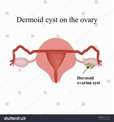 Dermoid Cyst Ovary Pictures