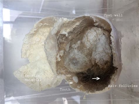 Dermoid Cyst Ovary