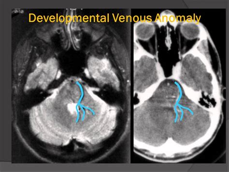 Developmental Venous Anomaly