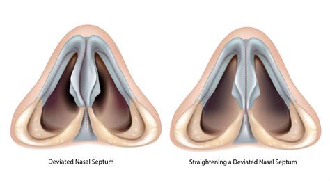 Deviated Nasal Septum Surgery