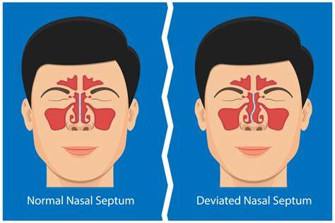Deviated Nasal Septum Treatments