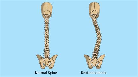 Dextroscoliosis Of The Lumbar Spine