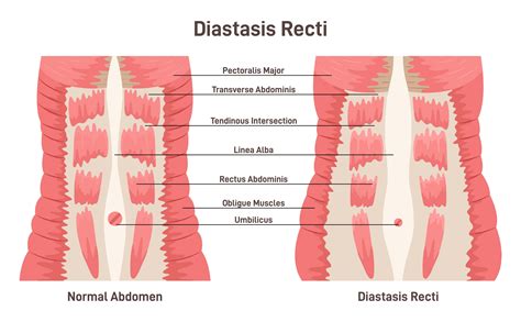 Diastasis Recti Operation
