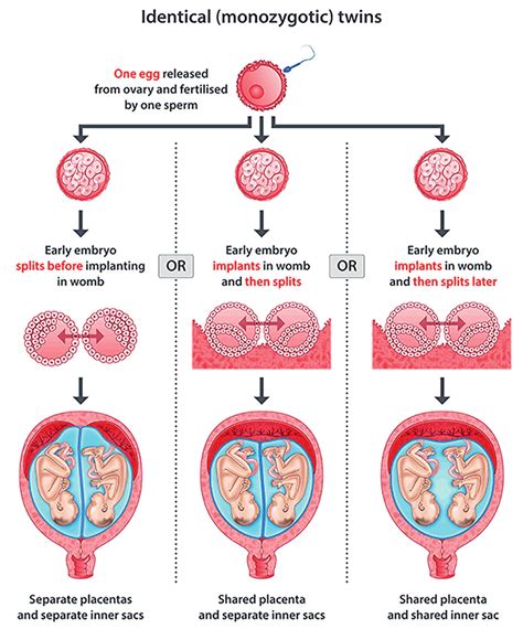 Dichorionic Diamniotic Twins