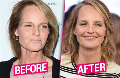 Did Helen Hunt Have Face Surgery