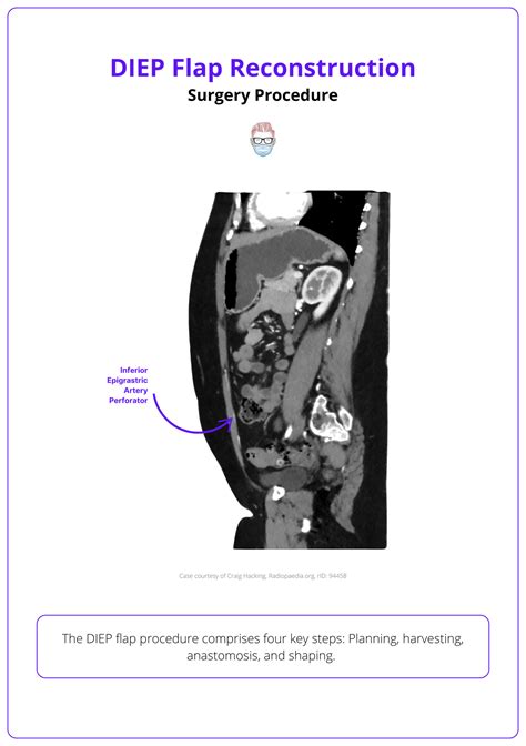 Diep Flap Procedure