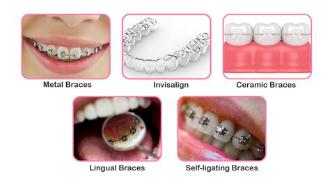 Different Types Of Braces