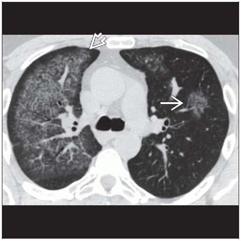 Diffuse Alveolar Hemorrhage