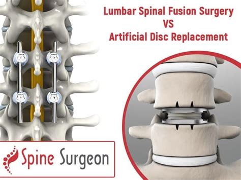 Disc Fusion Surgery Lumbar