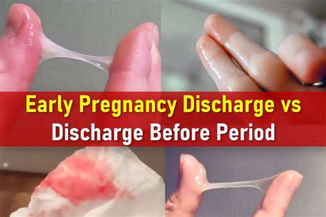 Discharge In Early Pregnancy