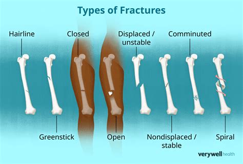 Displaced Vs Nondisplaced Fracture